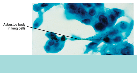 Asbestos particles in lung cells Asbestos particles in lung cells