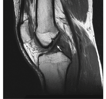 An MRI scan of a normal knee An MRI scan of a normal knee